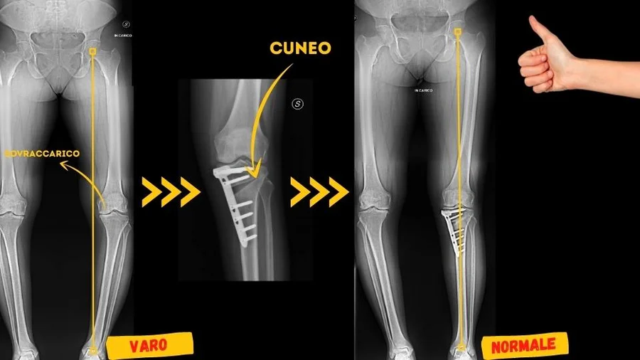Grafiche video youtube Osteotomia tibiale prossimale ginocchio varo