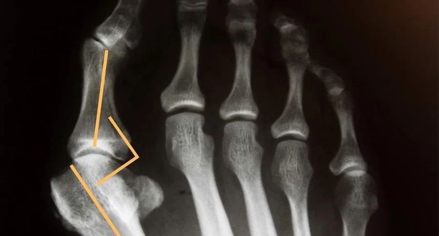 alluce valgo radiografia tecnica mini invasiva