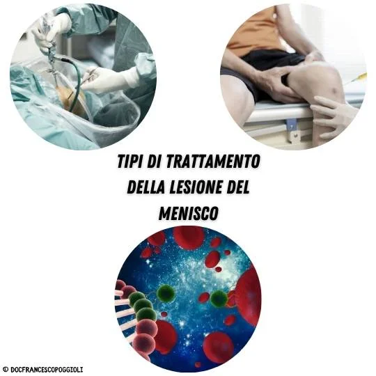 tipi di trattamento lesione del menisco poggioli