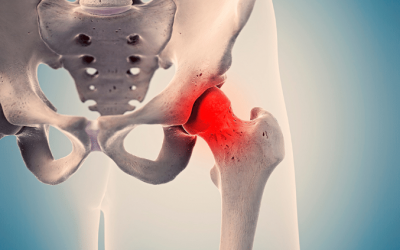 FAI (femoroacetabular impingement) o conflitto femoro-acetabolare