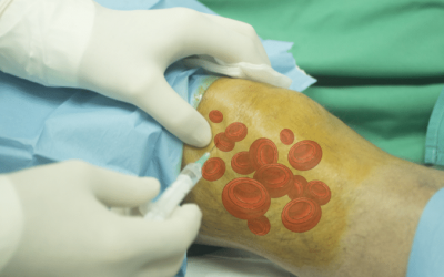 Plasma ricco di piastrine (PRP)e ginocchio…a che punto siamo?