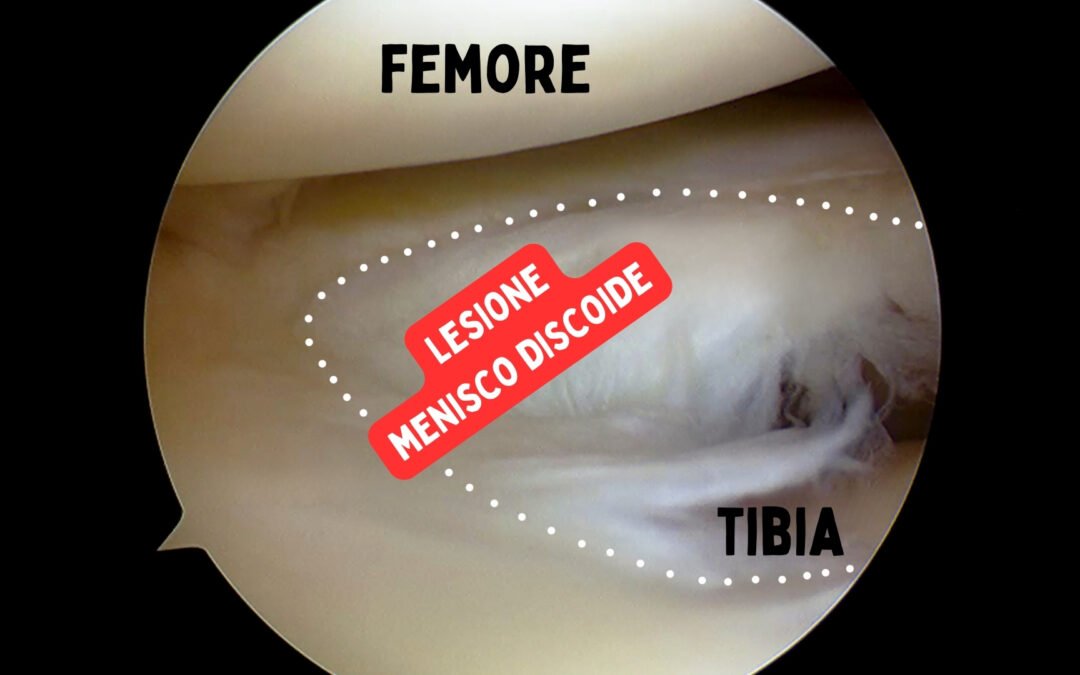 Le lesioni del menisco discoide nei bambini e negli adulti: come riconoscerlo e trattarlo