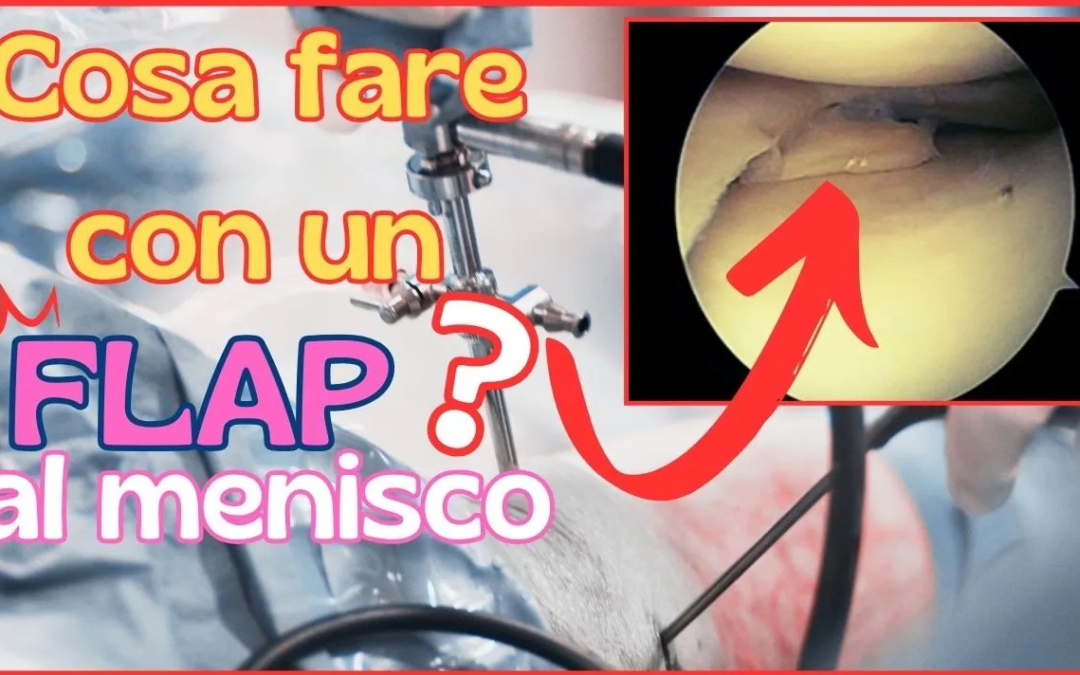 Lesioni a Flap del Menisco: Cosa Sono e Come Affrontarle